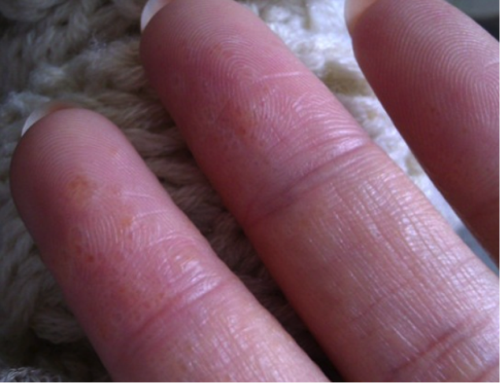 中西醫(yī)鵝掌風(fēng)怎樣治療，預(yù)防手癬的方法