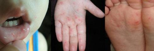 如何判斷孩子是否得了手足口